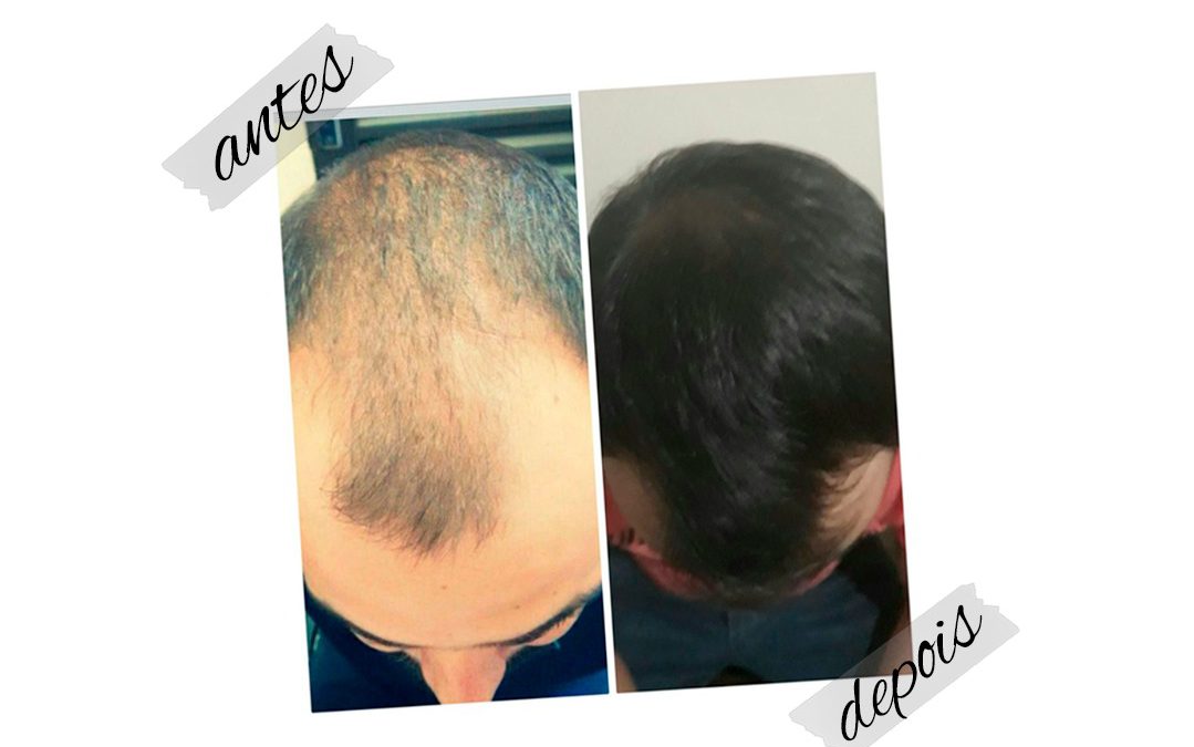 Com o kit Max Efetive Hair tratamento para Calvície, o resultado é garantido em até 90 dias de uso ! 😍
